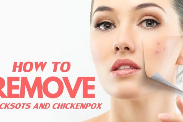 Remove ChickenPox Marks in Hindi – Get Rid of चेचक के दाग (Scars) How to Remove ChickenPox