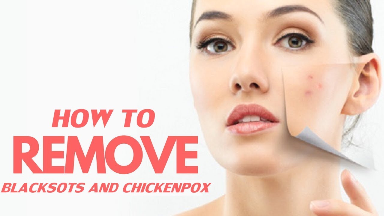 How to Remove ChickenPox