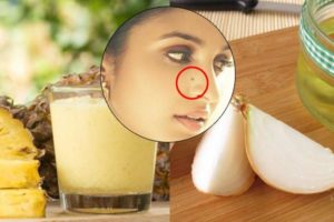 How to Remove Moles from Face Naturally