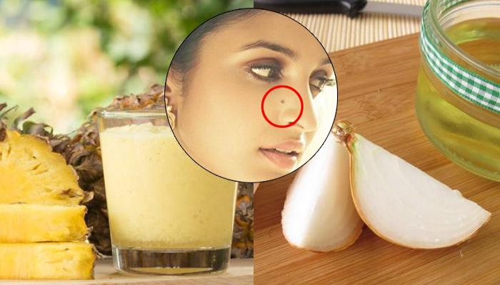 How to Remove Moles from Face Naturally