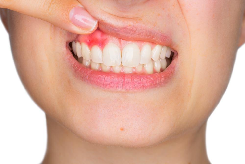 home remedies for gum problem